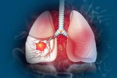 Lung Cancer Graphic