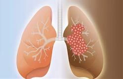healthy-lung-and-cancer-lung-385x247