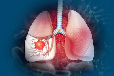 lung-cancer-screening-400x267