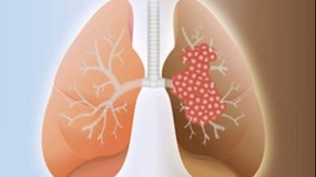 healthy-lung-and-cancer-lung-385x247
