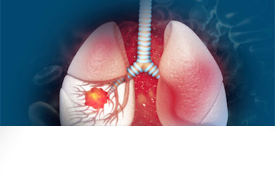lung-cancer-screening-385x247