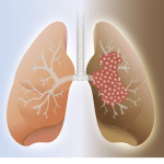 Healthy-lung-and-cancer-lung-150x150